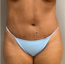 Tummy Tuck After Photo by Franklin Richards, MD; Bethesda, MD - Case 46531