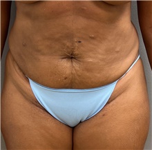 Tummy Tuck Before Photo by Franklin Richards, MD; Bethesda, MD - Case 46531