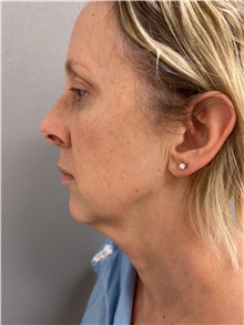 Facelift Before Photo by Franklin Richards, MD; Bethesda, MD - Case 47295