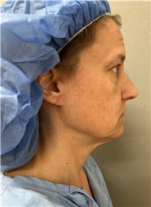 Facelift Before Photo by Franklin Richards, MD; Bethesda, MD - Case 47296
