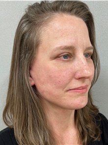 Facelift After Photo by Franklin Richards, MD; Bethesda, MD - Case 47296