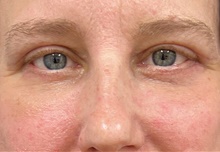 Eyelid Surgery After Photo by Franklin Richards, MD; Bethesda, MD - Case 47297