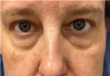 Eyelid Surgery Before Photo by Franklin Richards, MD; Bethesda, MD - Case 47297