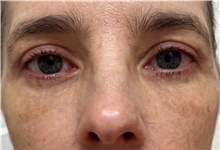 Eyelid Surgery After Photo by Franklin Richards, MD; Bethesda, MD - Case 47484