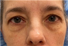 Eyelid Surgery Before Photo by Franklin Richards, MD; Bethesda, MD - Case 47484