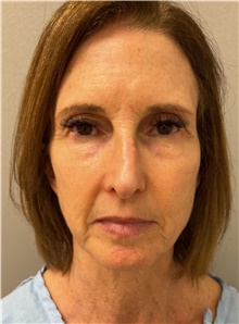 Facelift Before Photo by Franklin Richards, MD; Bethesda, MD - Case 47485