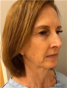 Facelift Before Photo by Franklin Richards, MD; Bethesda, MD - Case 47485