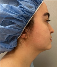 Liposuction Before Photo by Franklin Richards, MD; Bethesda, MD - Case 47635