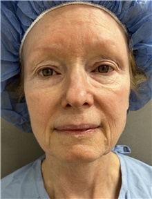 Facelift Before Photo by Franklin Richards, MD; Bethesda, MD - Case 47829