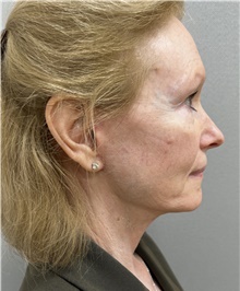 Facelift After Photo by Franklin Richards, MD; Bethesda, MD - Case 47829