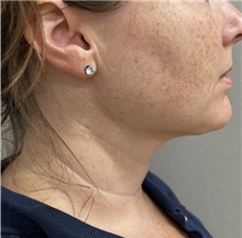 Neck Lift After Photo by Franklin Richards, MD; Bethesda, MD - Case 47830