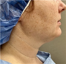 Neck Lift Before Photo by Franklin Richards, MD; Bethesda, MD - Case 47830
