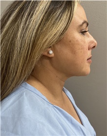 Liposuction After Photo by Franklin Richards, MD; Bethesda, MD - Case 47911