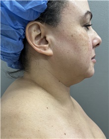 Liposuction Before Photo by Franklin Richards, MD; Bethesda, MD - Case 47911