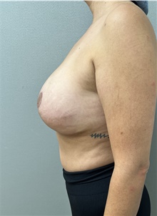 Breast Lift After Photo by Franklin Richards, MD; Bethesda, MD - Case 47949