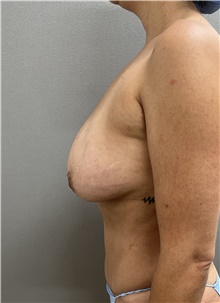Breast Lift Before Photo by Franklin Richards, MD; Bethesda, MD - Case 47949