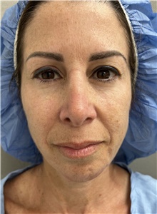 Facelift Before Photo by Franklin Richards, MD; Bethesda, MD - Case 47951