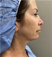 Facelift Before Photo by Franklin Richards, MD; Bethesda, MD - Case 47951