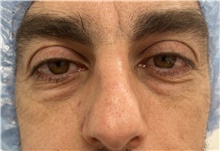 Eyelid Surgery Before Photo by Franklin Richards, MD; Bethesda, MD - Case 48063