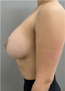 Breast Augmentation After Photo by Franklin Richards, MD; Bethesda, MD - Case 48119