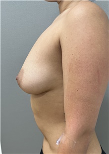 Breast Augmentation Before Photo by Franklin Richards, MD; Bethesda, MD - Case 48119