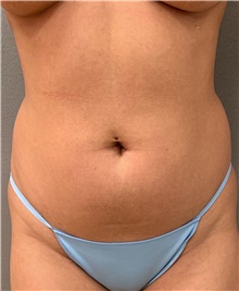 Liposuction Before Photo by Franklin Richards, MD; Bethesda, MD - Case 48143