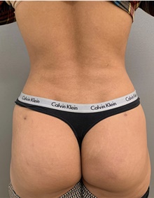 Liposuction After Photo by Franklin Richards, MD; Bethesda, MD - Case 48143