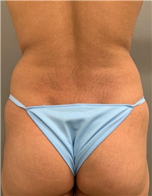 Liposuction Before Photo by Franklin Richards, MD; Bethesda, MD - Case 48143