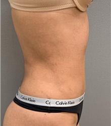 Liposuction After Photo by Franklin Richards, MD; Bethesda, MD - Case 48143