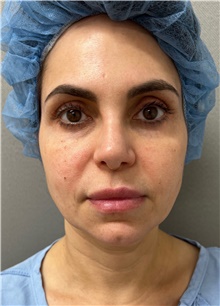 Facelift Before Photo by Franklin Richards, MD; Bethesda, MD - Case 48501