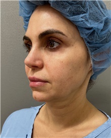 Facelift Before Photo by Franklin Richards, MD; Bethesda, MD - Case 48501