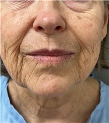 Laser Skin Resurfacing Before Photo by Franklin Richards, MD; Bethesda, MD - Case 48591