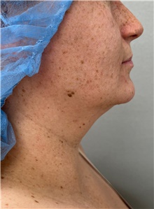 Liposuction Before Photo by Franklin Richards, MD; Bethesda, MD - Case 48639