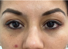 Eyelid Surgery After Photo by Franklin Richards, MD; Bethesda, MD - Case 48640
