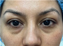 Eyelid Surgery Before Photo by Franklin Richards, MD; Bethesda, MD - Case 48640