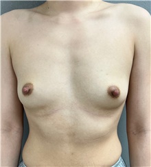 Breast Augmentation Before Photo by Franklin Richards, MD; Bethesda, MD - Case 48641