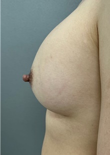 Breast Augmentation After Photo by Franklin Richards, MD; Bethesda, MD - Case 48641