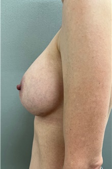 Breast Augmentation After Photo by Franklin Richards, MD; Bethesda, MD - Case 48653