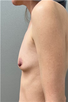 Breast Augmentation Before Photo by Franklin Richards, MD; Bethesda, MD - Case 48653