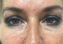 Eyelid Surgery After Photo by Franklin Richards, MD; Bethesda, MD - Case 49058