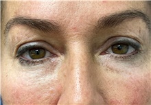 Eyelid Surgery Before Photo by Franklin Richards, MD; Bethesda, MD - Case 49058