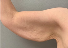 Arm Lift Before Photo by Franklin Richards, MD; Bethesda, MD - Case 49059