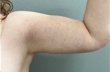 Arm Lift After Photo by Franklin Richards, MD; Bethesda, MD - Case 49059