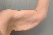 Arm Lift Before Photo by Franklin Richards, MD; Bethesda, MD - Case 49059