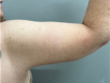 Arm Lift After Photo by Franklin Richards, MD; Bethesda, MD - Case 49059