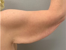 Arm Lift Before Photo by Franklin Richards, MD; Bethesda, MD - Case 49059