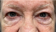 Eyelid Surgery Before Photo by Franklin Richards, MD; Bethesda, MD - Case 49060