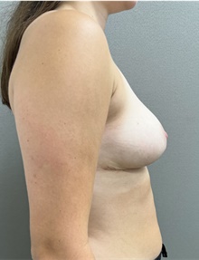 Breast Reduction After Photo by Franklin Richards, MD; Bethesda, MD - Case 49121