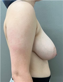 Breast Reduction Before Photo by Franklin Richards, MD; Bethesda, MD - Case 49121