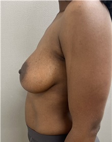 Breast Augmentation After Photo by Franklin Richards, MD; Bethesda, MD - Case 49147